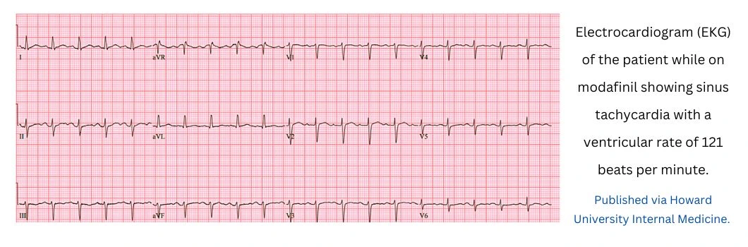 modafinil-and-tachycardia