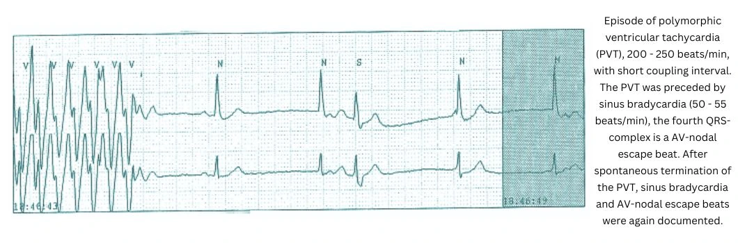 ventricular-tachycardia-from-modafinil